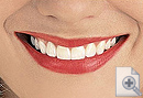 Teeth whitening (Bleacning)