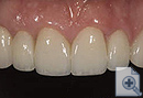 Replacing the small incisor with bridge
