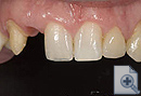 Replacing the small incisor with bridge