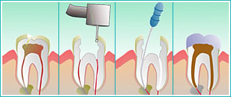 Root Canal Treatment